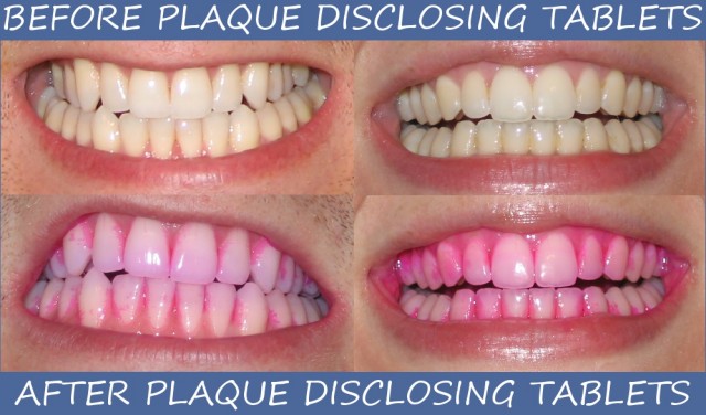 Plaque Disclosing Tablets Can Help You Brush Better | Oral