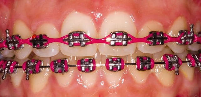 Colored Braces Single Tooth or All The Teeth