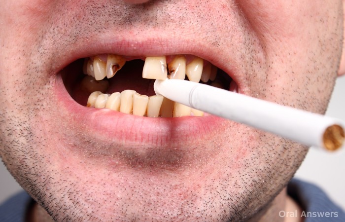 Smokers Have Less Teeth Than Non-Smokers