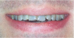 teeth discoloration drug use