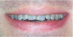 Tetracycline Teeth Staining