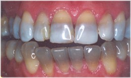 minocycline and yellow teeth