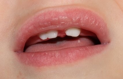 Tooth Twinning / Gemination - Close Up View