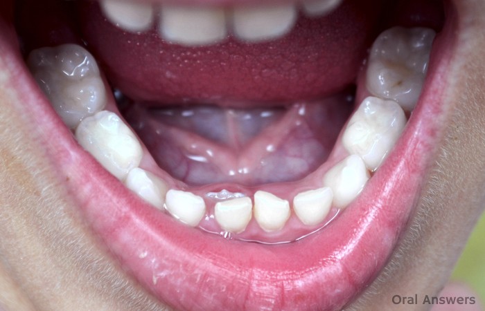 Adult Teeth Growing Behind Baby Teeth 69