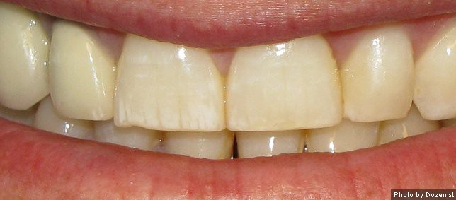 Dental Fluorosis