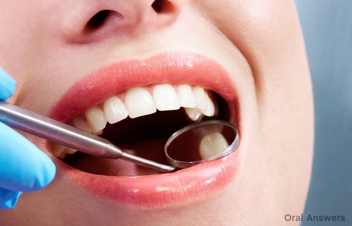 Most Likely Places to Get a Cavity