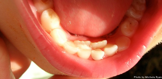 Shark Teeth - Permanent Teeth Coming In Behind Baby Teeth