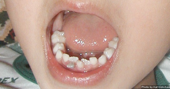 Growing out sideways tooth How to