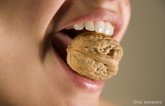 Easy Ways to Crack or Chip Your Teeth