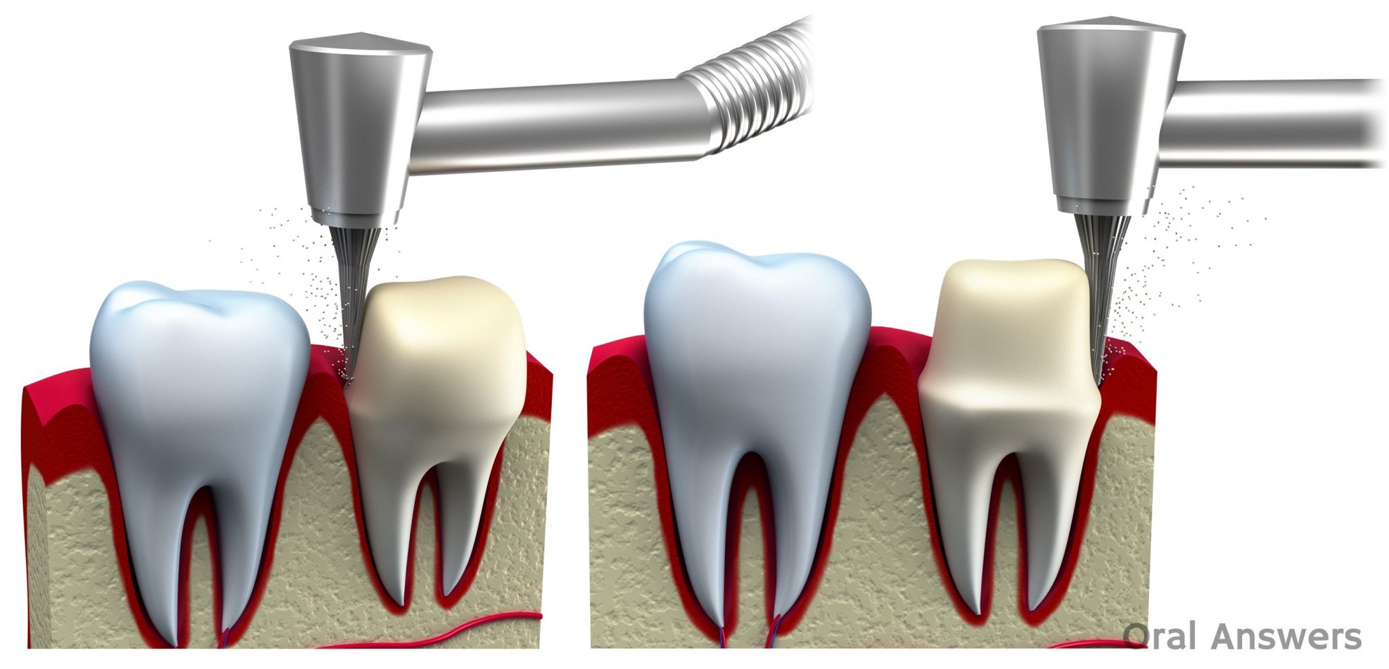 Dental Crown Procedure What is a Dental Crown / Cap? Oral Answers