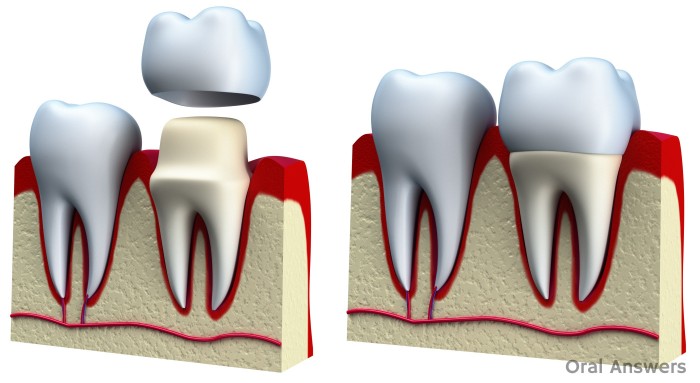 Dental Crown Getting Seated and Cemented