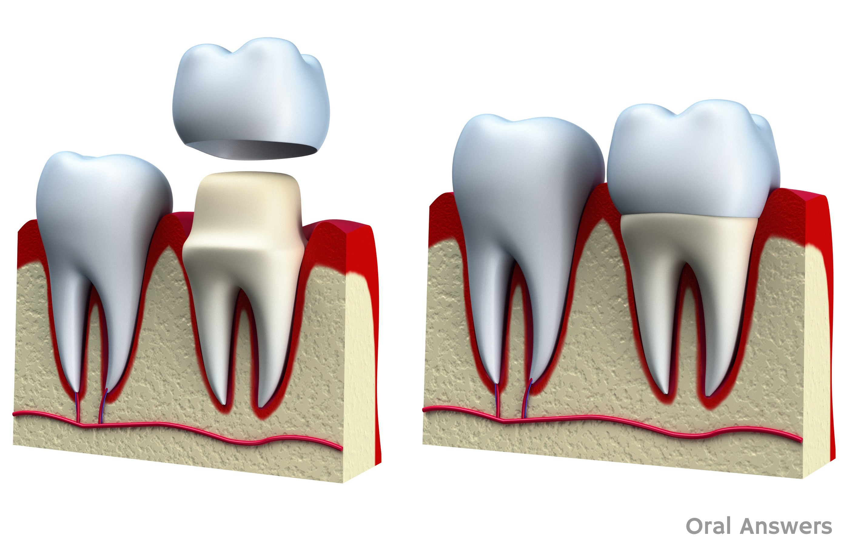 Dental Crown Procedure: What is a Dental Crown / Cap? | Oral Answers