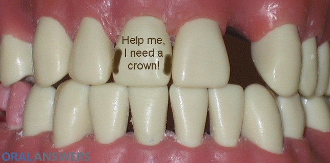 Dental Crown Tooth Before Being Prepared for Crown
