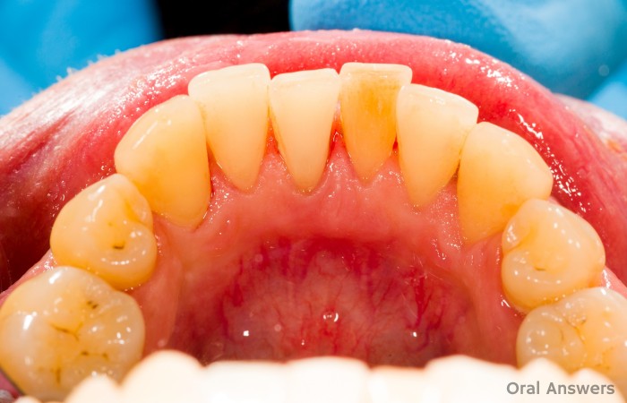 Dental Tartar and Calculus After Dental Cleaning