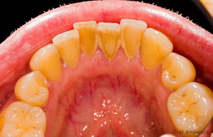 Dental Tartar and Calculus Before Cleaning