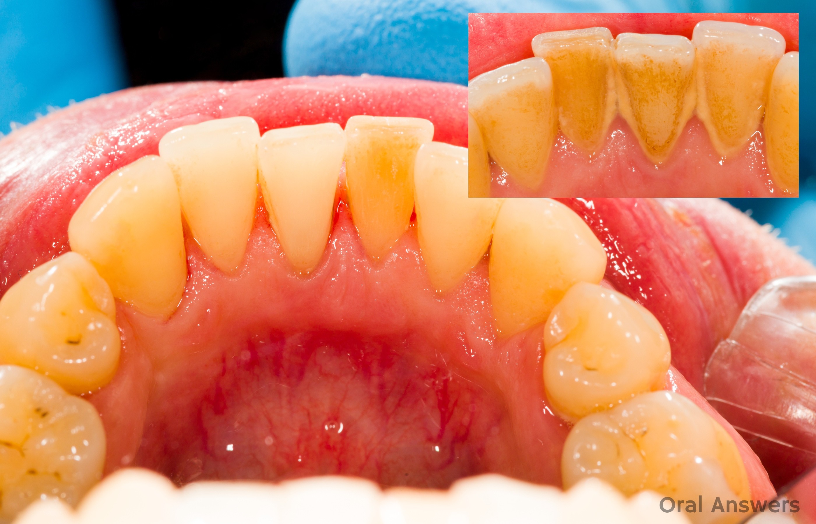 tartar buildup back teeth