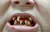 Meth Mouth Destroys Teeth
