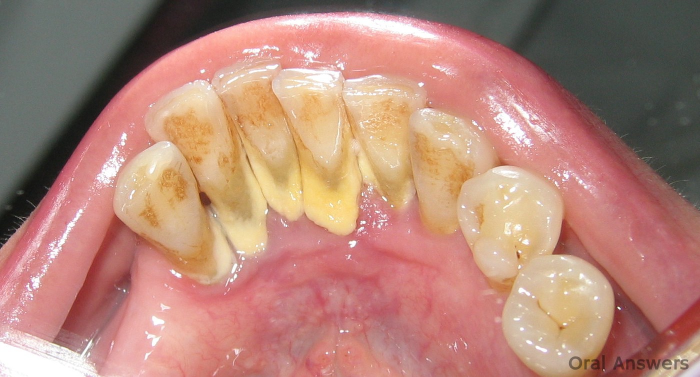 photos of teeth with tartar