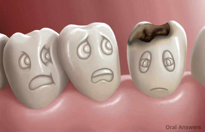 Tooth Decay Serious Disease