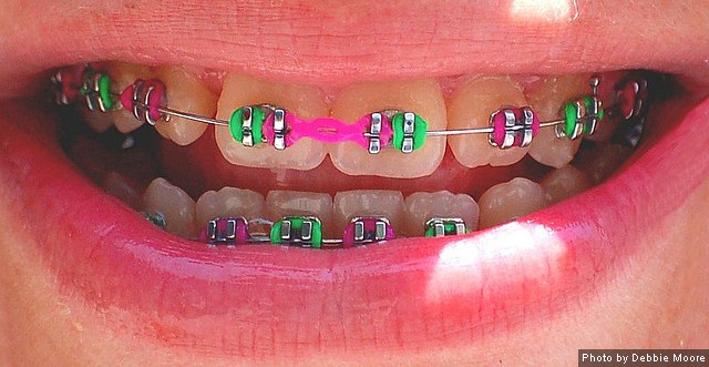 Two Rubber Ligatures on One Bracket with Braces