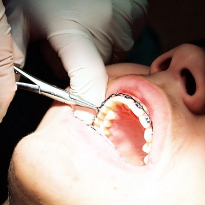 how long should my teeth hurt after braces