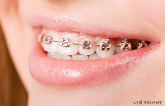 Why Braces Have Two Colored Bands Around Them