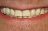Dental Fluorosis Stains Teeth Chalky White