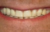 Dental Fluorosis Stains Teeth Chalky White