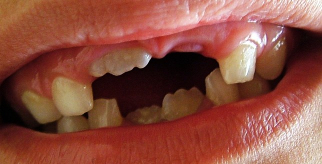 Mamelons on New Permanent Teeth