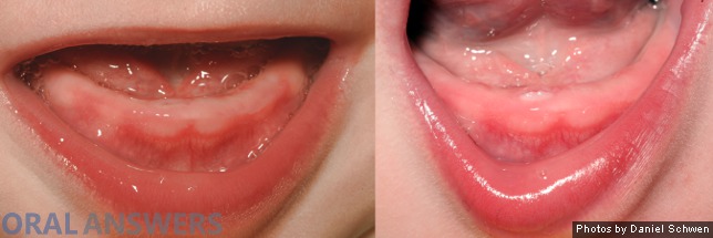 Teething: Baby's First Tooth