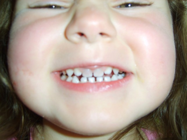 baby teeth discoloration fall