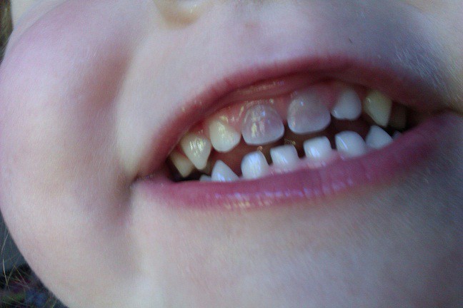 discoloration of teeth in children