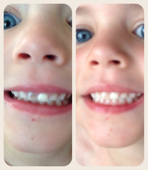 Dark Tooth Turned White Again
