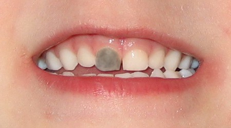 trauma baby teeth discoloration