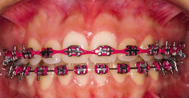 Before And After Braces Gaps. Labial Frenectomy After Braces