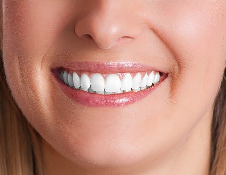 Teeth Whitening or Bleaching?