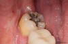 Contents of Silver Amalgam Fillings