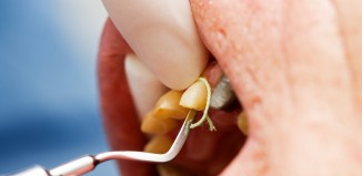 Dental Retraction Cord In Gums