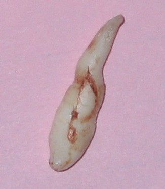 Supernumerary Teeth: Mesiodens