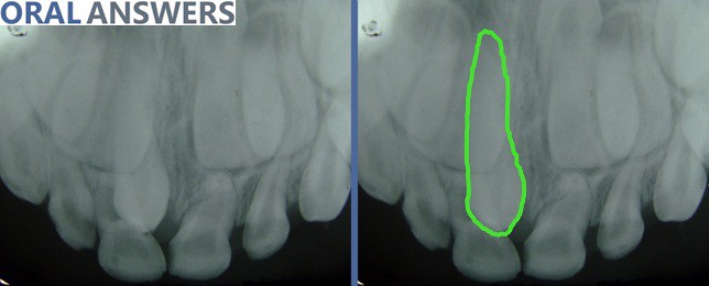 Extra Teeth: Supernumerary Mesiodens Tooth
