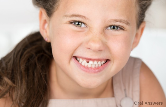 Congenitally Missing Teeth