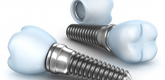 Dental implant Parts