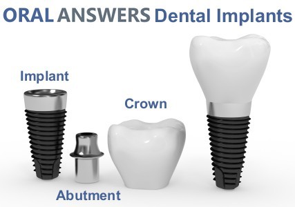 Parts of a Dental Implant