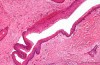 Keratocystic Odontogenic Tumor