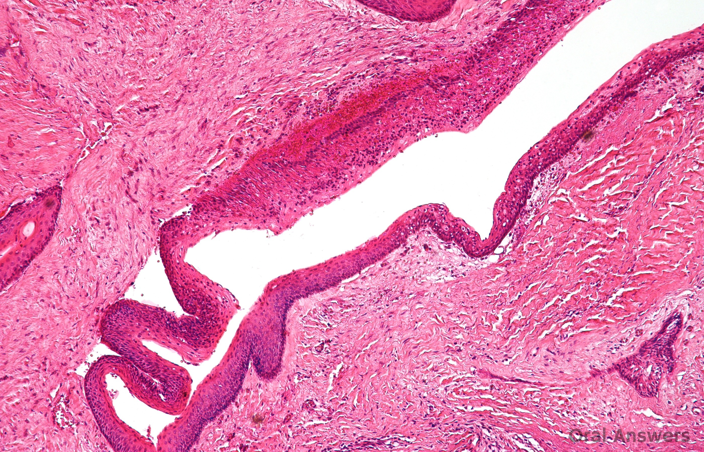 Picture of Epidermal Inclusion Cyst (EIC) on MedicineNet