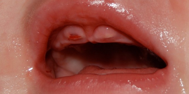 newborn with tooth