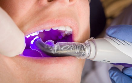 Do I Need a Filling?