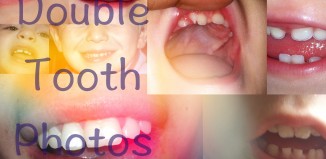 Double Tooth Photos