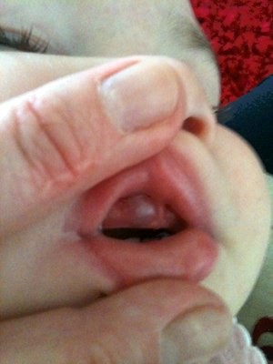 Fluid filled bubble on inner lower lip - Ear, Nose ...