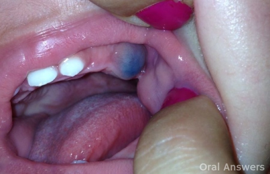 Purple Spot In Mouth 121
